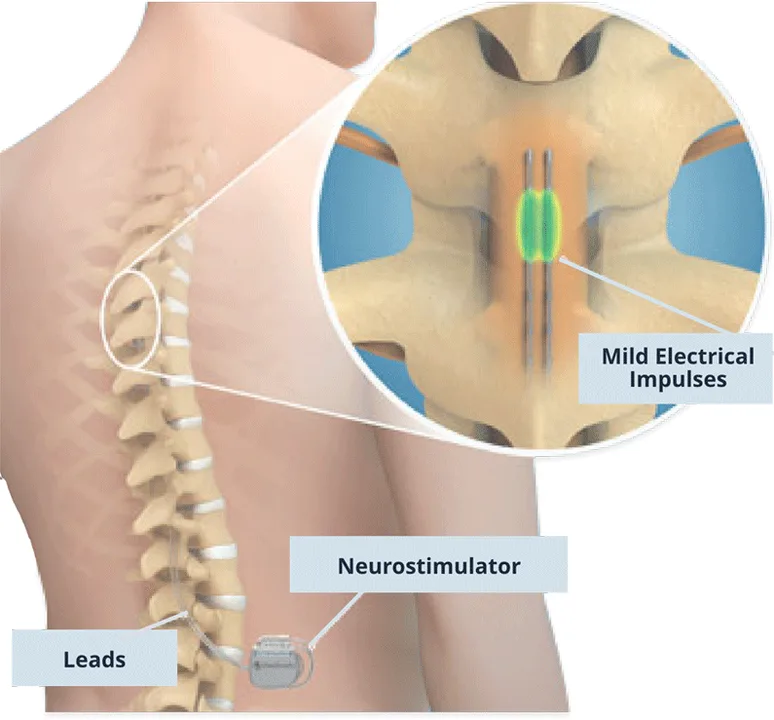 Prevent Payers from Dictating Pain Care Pathway