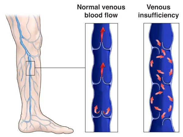 Treat Venous Insufficiency 