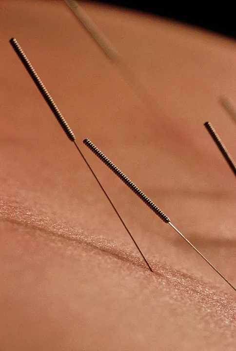 Acupuncture services on the Florida Adult Cystic Fibrosis Waiver Program