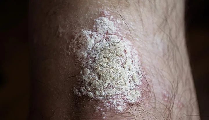 Congress, please help pass important psoriasis legislation