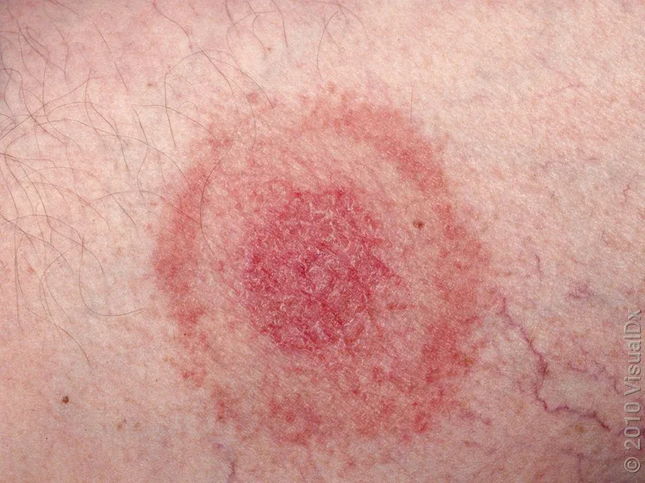 UK Lyme Petition