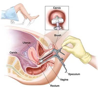 Campaign to get the age of Cervical Smears reduced to 20
