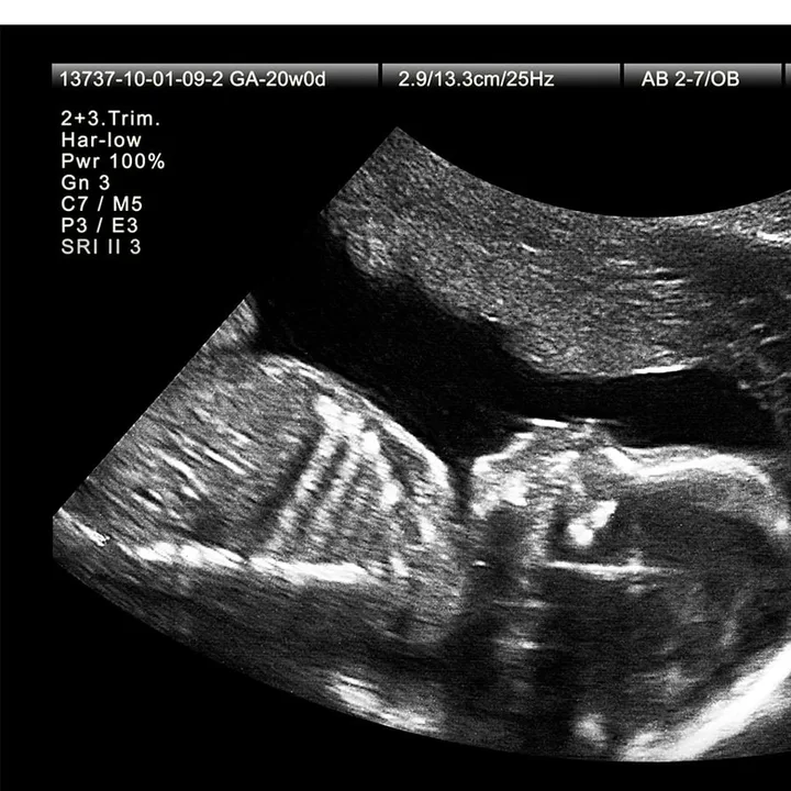 Support A 20 Week Abortion Ban