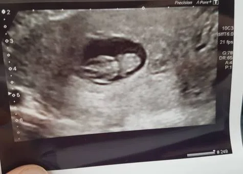 Miscarriage Pay