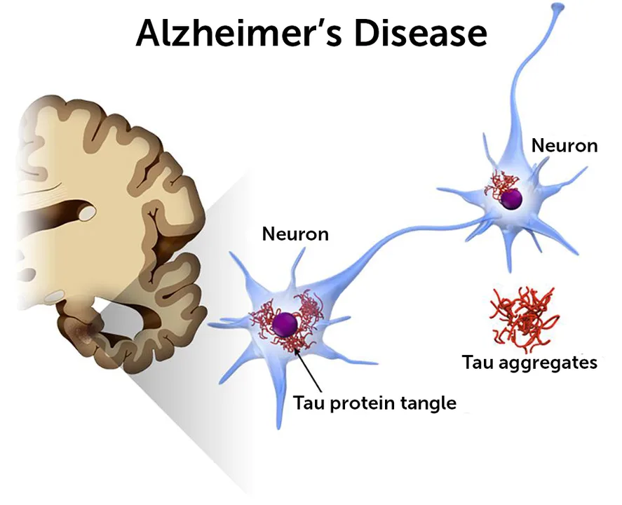 TheAlzheimer\'sDiseasepetition