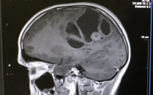 Mandatory MRI for all 12 year olds! STOP BRAIN TUMOURS