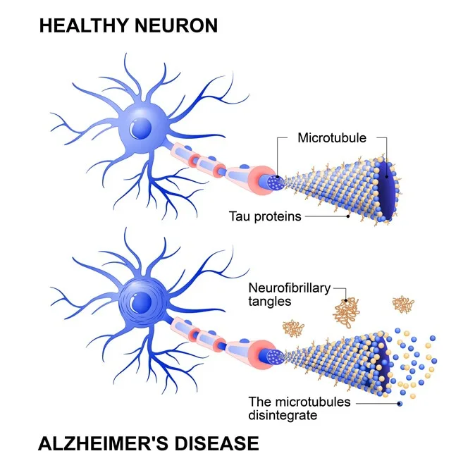  End Alzheimers