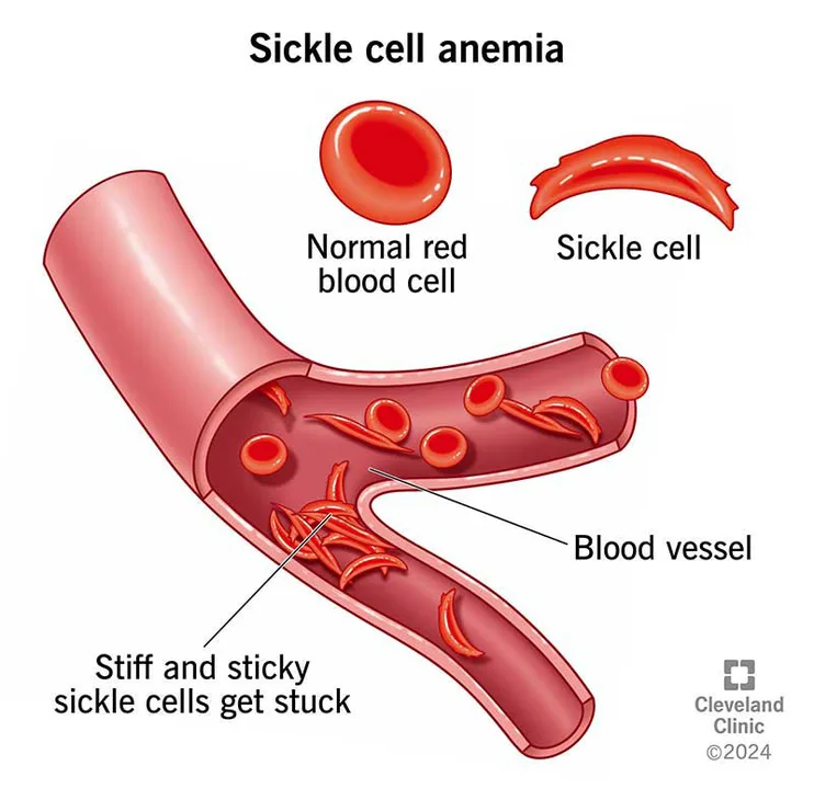 VOTE FOR THE TEXAS SICKLE CELL DISEASE PROGRAM