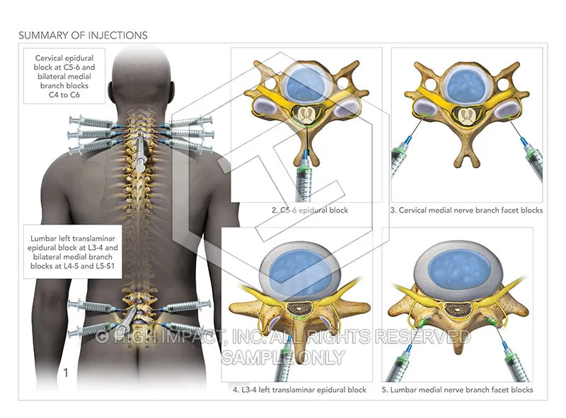 Help Get Debra Halvorsen Her Nerve Block Procedure