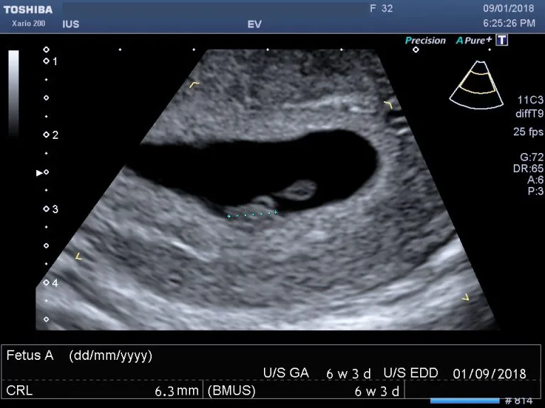 Abortion End's A Child's Right To Life.