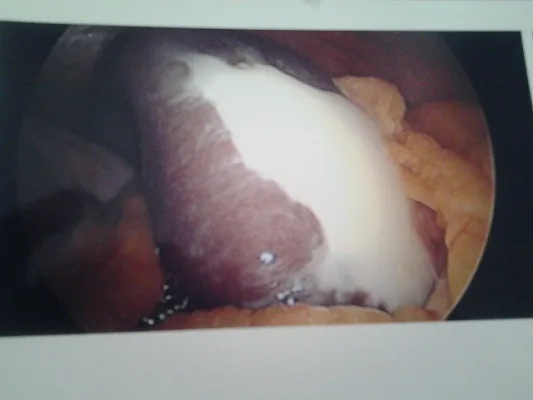 Lift the Statute of Limitations for Gastric Lapband Patients with Damage