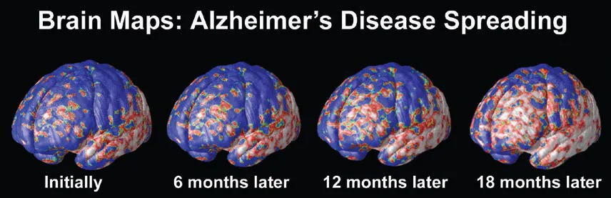 National Alzeheimer's Project Act