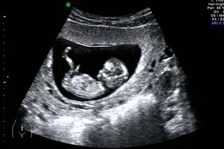 Free NHS Scans for all women at 12 weeks of pregnancy!!!
