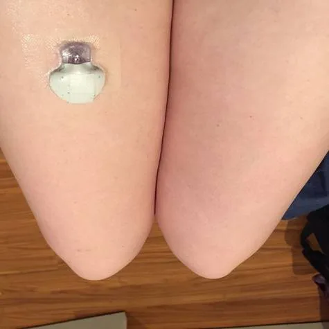Funding for Continuous Glucose Monitors