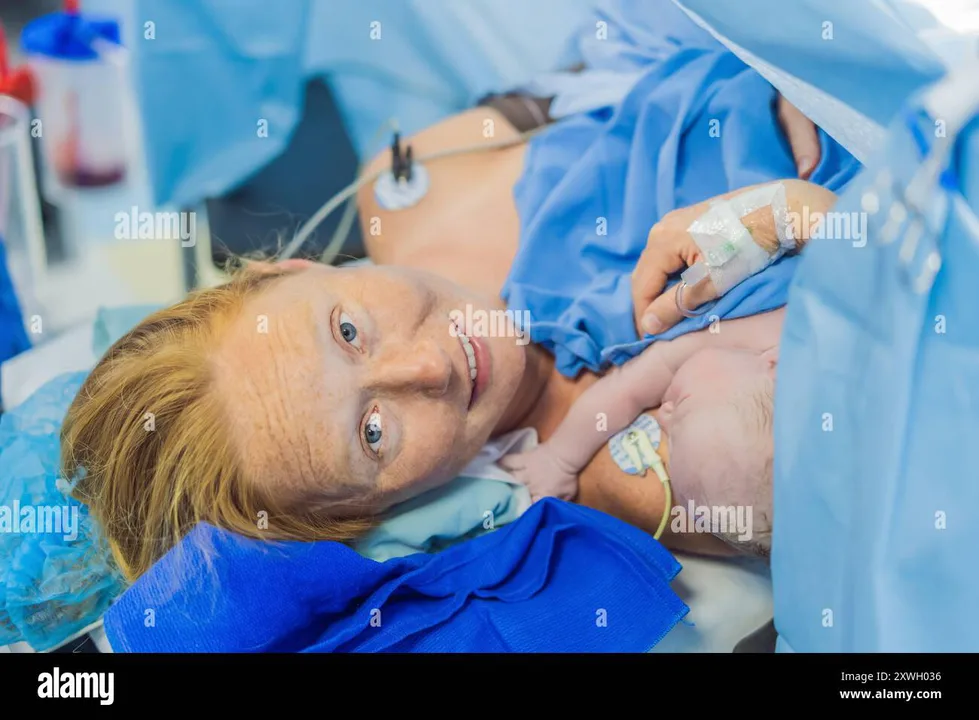 Support breast feeding after cesarean