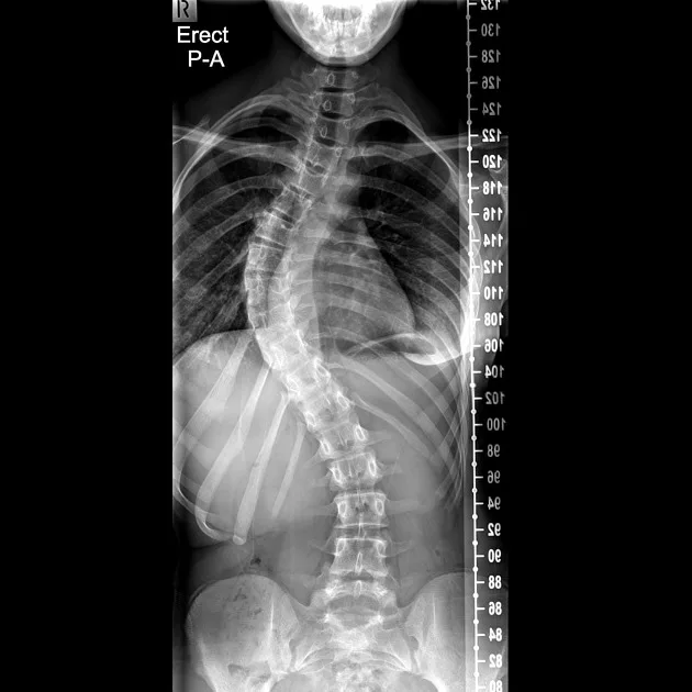 Save adult scoliosis provision in Scotland 