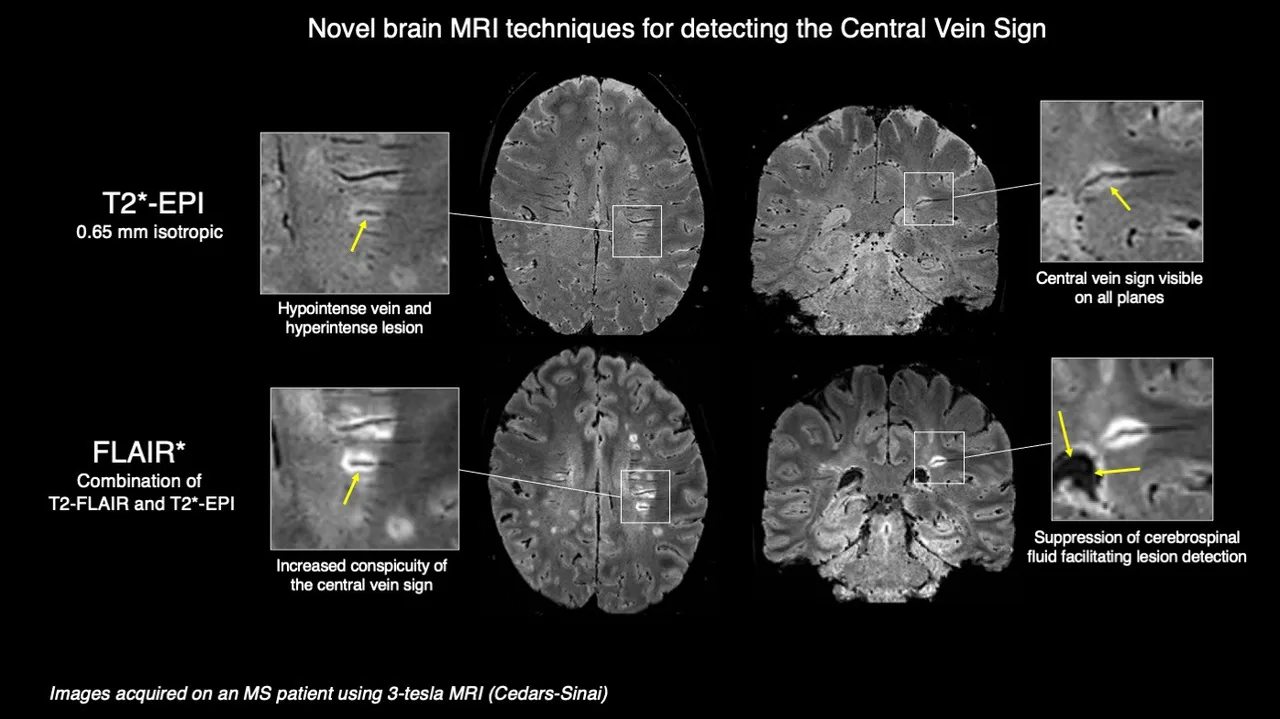 CCSVI Testing Mandatory for people with MS