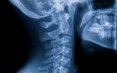 Citizens for Chiropractic and the Continued Use of X-rays