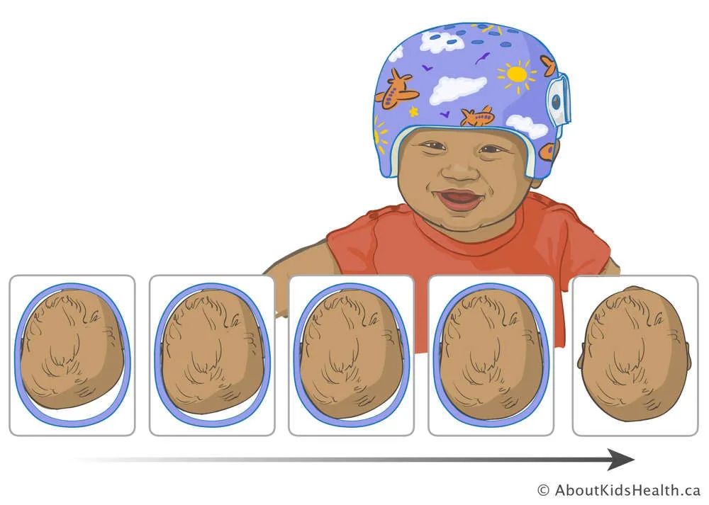 Plagiocephaly treatment for babies on the NHS